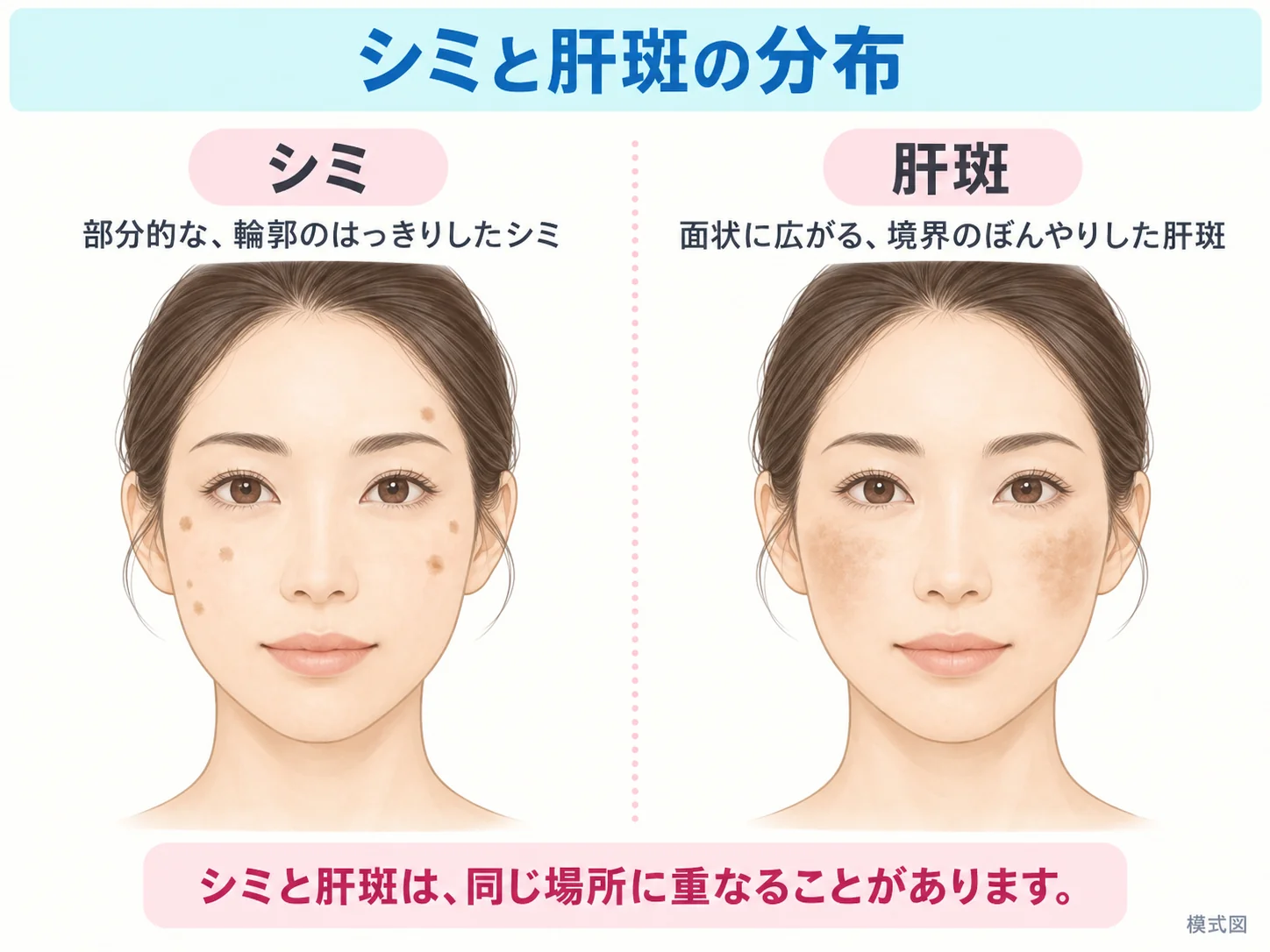 シミと肝斑の分布を示す模式図。輪郭のはっきりした部分的なシミと、境界がぼんやりした面状の肝斑は、同じ場所に重なることがあります。