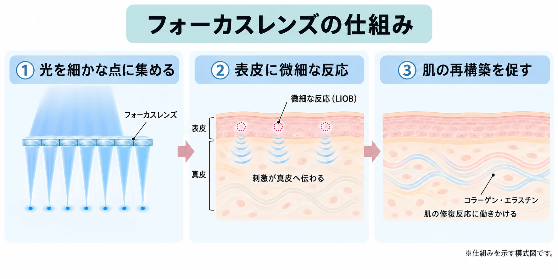 フォーカスレンズの仕組みを示す3段階の模式図。1:光を細かな点に集める。2:表皮でLIOBと呼ばれる微細な反応が起き、その刺激が真皮へ伝わる。3:肌の修復反応を通じてコラーゲンやエラスチンの生成を促す。