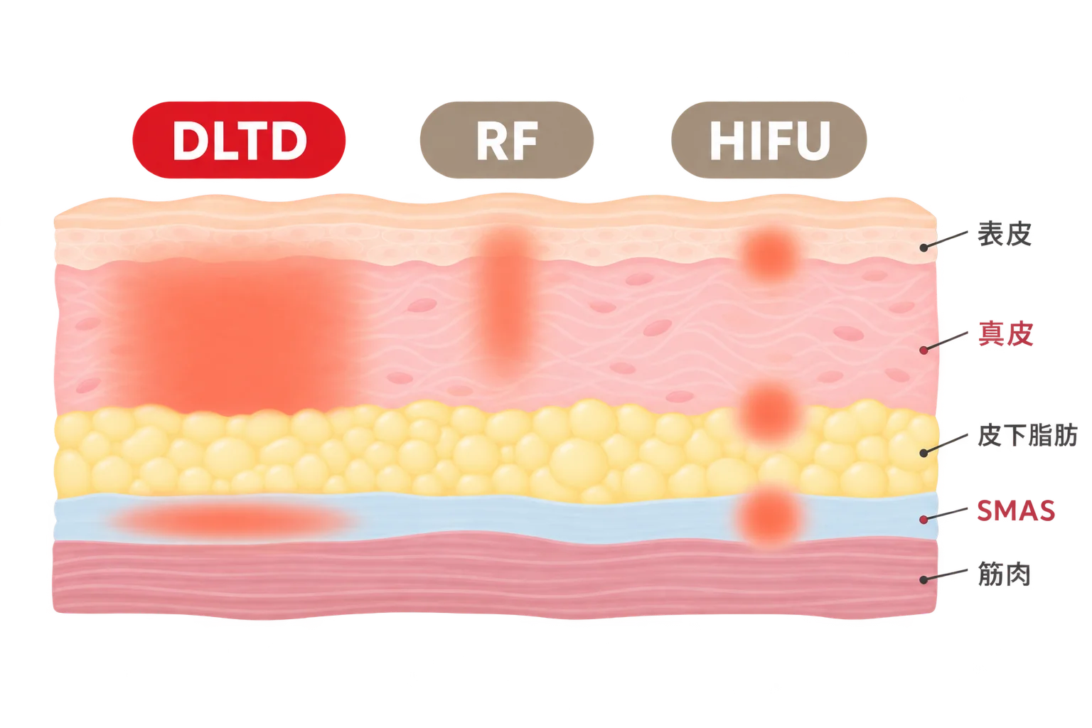 DLTD・RF・HIFUの作用部位のイメージを示した皮膚断面の模式図