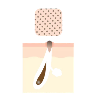 黒ずみ毛穴のイラスト