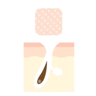 開き毛穴のイラスト