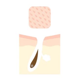 たるみ毛穴のイラスト