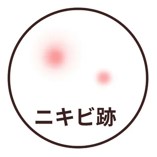 ニキビ跡の赤みのイラスト