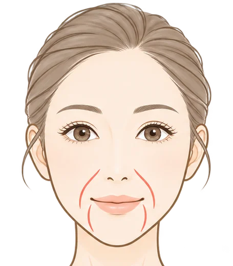 たるみによる深いしわのイラスト